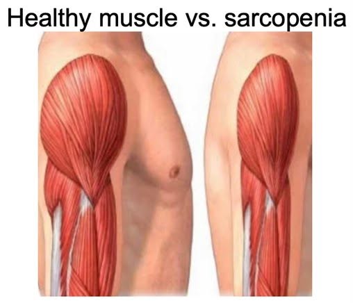 Have you ever heard of sarcopenia?