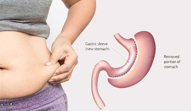 What is gastric resection surgery? What conditions must be met for gastric resection for weight loss? What are the effects on the body and mind after surgery?